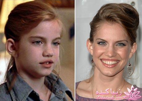 جراحی بینی - جراحی زیبایی